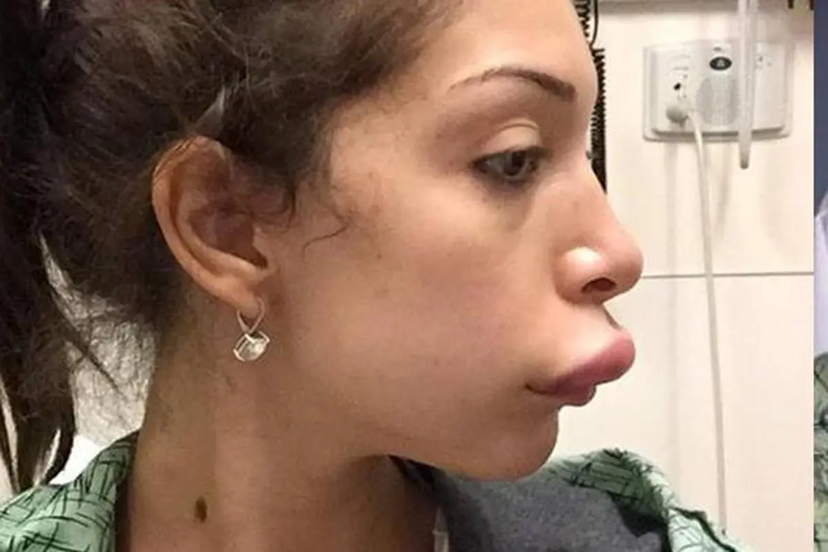 Mau Seksi, Bibir Wanita Ini Terlihat Seperti Mulut Bebek