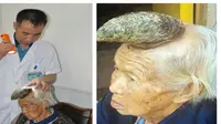 Nenek Ini Punya 'Tanduk' di Kepala