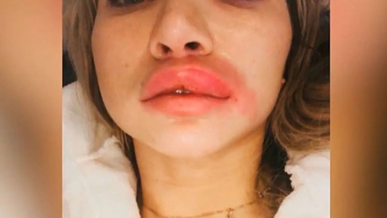 Ingin Cantik, Wanita Ini Nekat Menginjeksi Wajahnya dengan Zat Asing