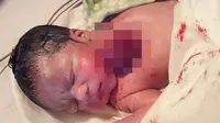 Tragis, Bayi Terlahir dengan Jantung Diluar Tubuh