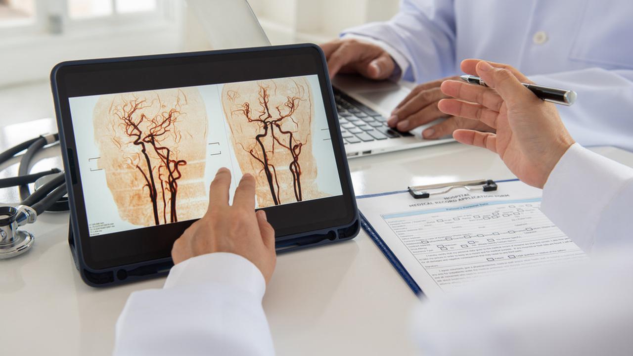 Ilustrasi stroke iskemik