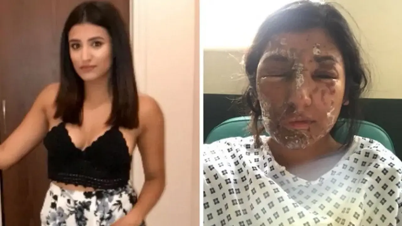 Resham Khan sebelum dan sesudah kejadian penyiraman air keras (GOFUNDME)