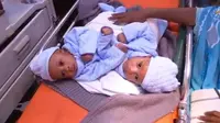 Tim dokter bedah di Paris akhirnya berhasil memisahkan bayi laki-laki yang kembar siam