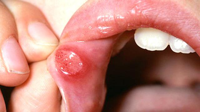 10 Penyebab Kanker Mulut yang Perlu Diwaspadai, Kenali Tanda-Tandanya
