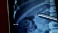 Bocah Telan Pensil Saat Hilangkan Sisa Bakso di Gigi