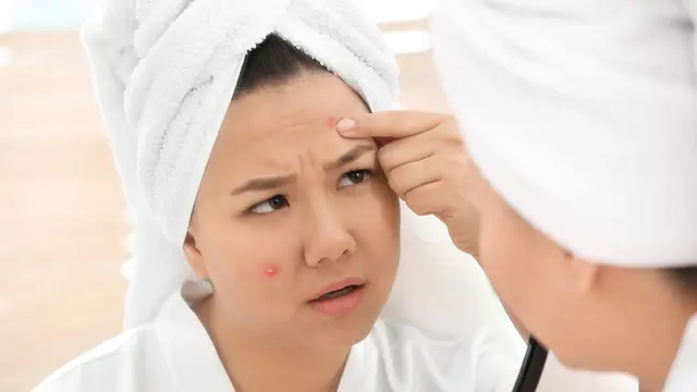 Perawatan Wajah Akurat untuk Atasi Bekas Jerawat, Acne Fighter Wajib Merapat!