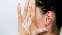 Dokter Ingatkan Dampak Vitiligo Tak Hanya pada Kulit