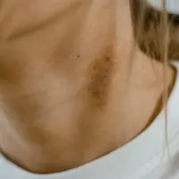 Tubuh sering muncul lebam padahal tidak terbentur? Berikut beberapa penyebabnya!/copyright pexels/MART PRODUCTION