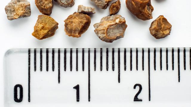 Ilustrasi Batu Ginjal pada Anak (iStockphoto)