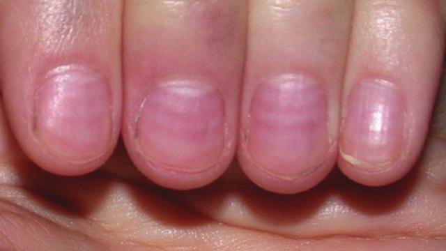 5 Warna Pada Kuku Kaki Ternyata Bisa Ungkap Kesehatanmu
