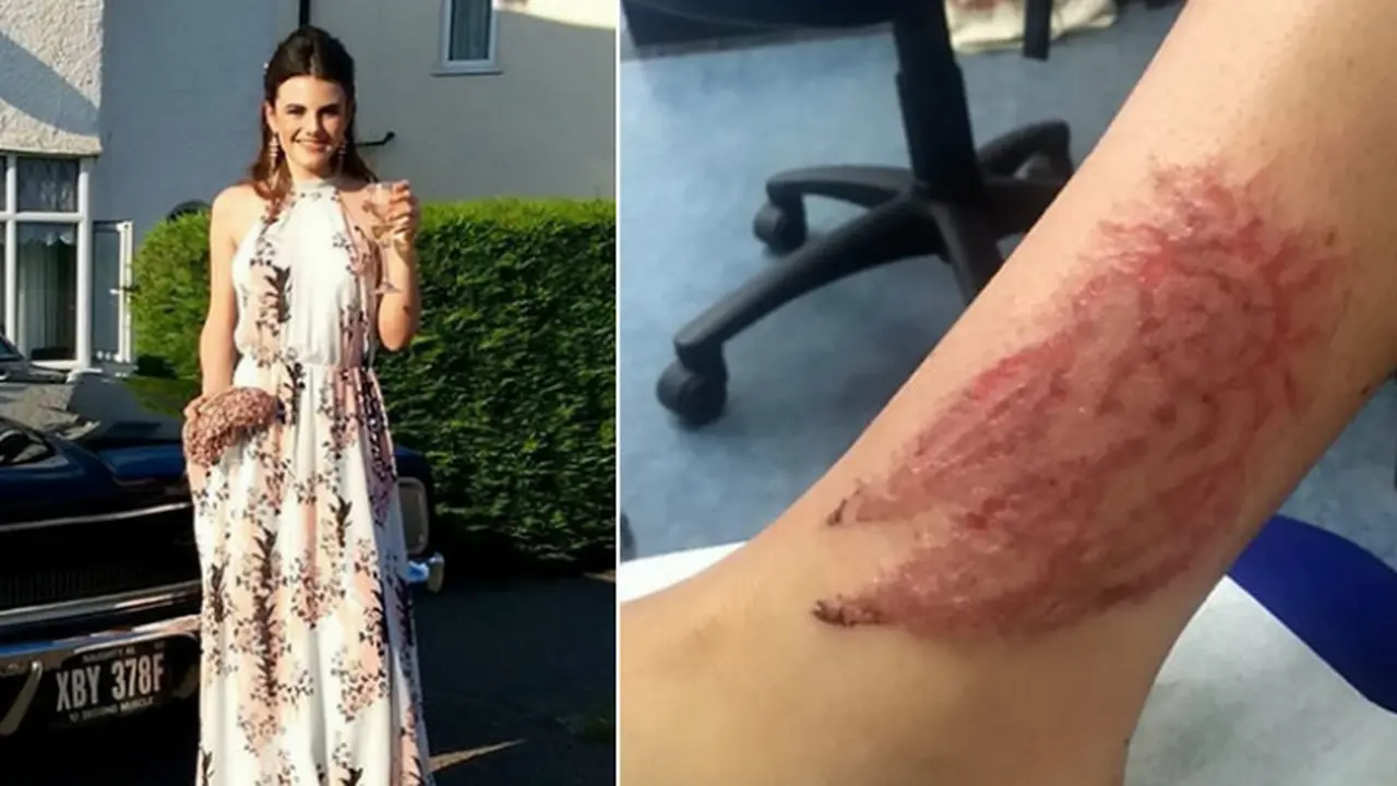 Gara-Gara Tato Henna, Kulit Remaja Ini Rusak