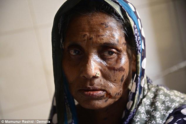 Sang ibu mengalami luka bakar di wajah akibat serangan misterius yang menimpanya dan menimpa buah hatinya | Photo: Copyright asiantown.net
