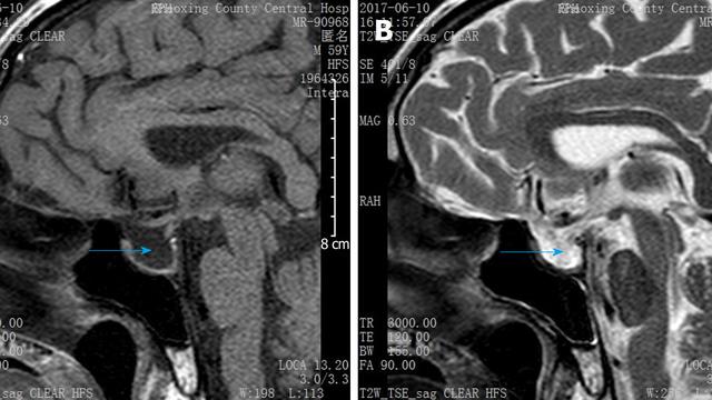 Mengenal Empty Sella Syndrome, Penyakit Langka yang Dapat Pengaruhi ...