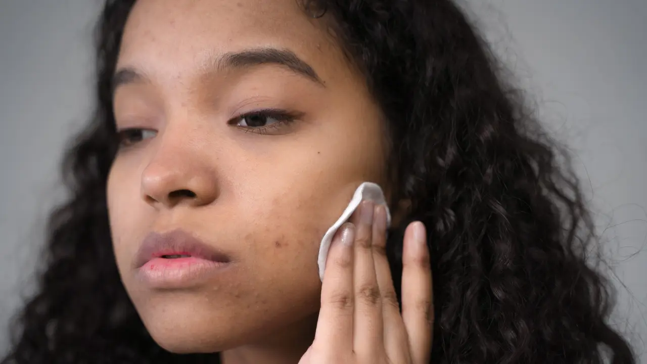 Kenali Purging dan Breakout Sebelum Mengubah Rutinitas Skincare