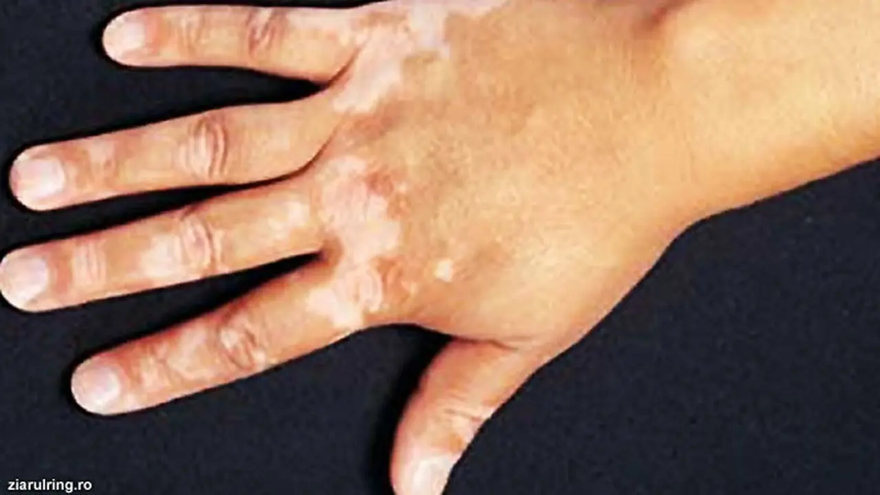 vitiligo-130715b.jpg