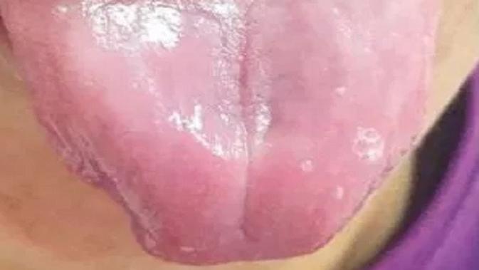 Lidah pria ini kehilangan papilanya karena kurang vitamin (Tangkapan Layar The Sun)
