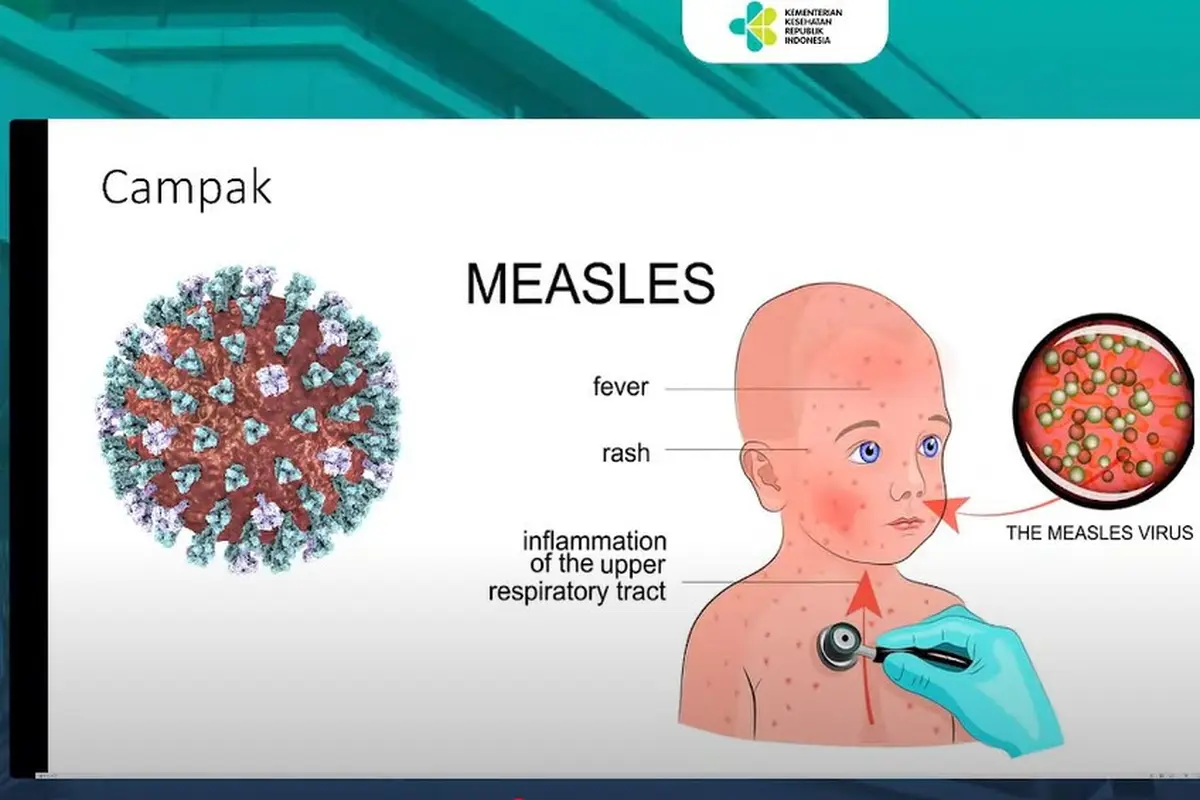 Virus campak seperti dipaparkan Prof Hartono (Tangkapan Layar Youtube Kemenkes)