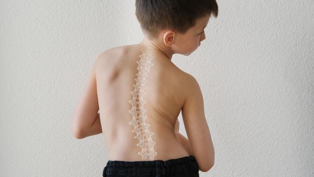 Jangan Anggap Remeh Skoliosis, Ini Langkah Pencegahan dan Penanganan Tepat