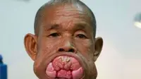 Operasi yang Mengubah Hidup Pria Pemilik Tumor Mulut Terbesar
