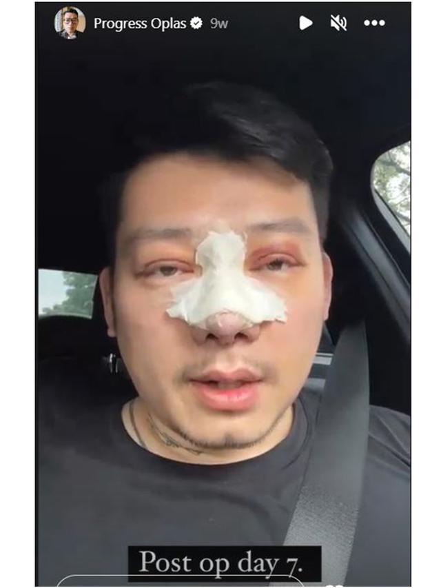 7 Potret Chef William Gozali Jalani Operasi Plastik, Perubahannya Bikin Pangling