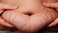 Punya Stretch Mark? Bisa Jadi Itu Keturunan