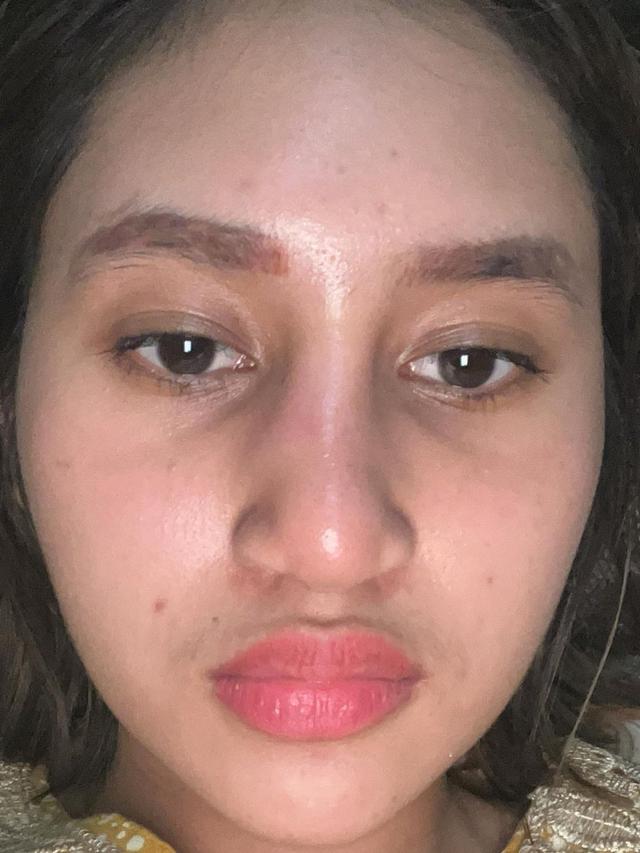 Sempat Oplas, Ini 6 Potret Permesta Dhyaz Anak Farida Nurhan Alami Infeksi Implan