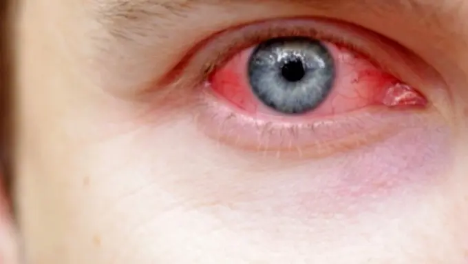 Kenapa Sakit Mata Mudah Menular?