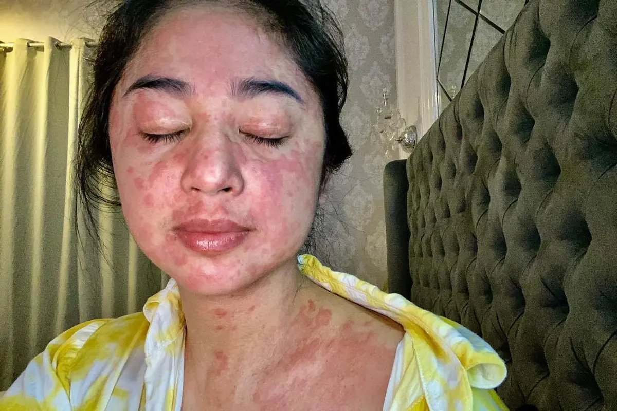 7 Potret Dewi Perssik saat Alami Gejala Corona Covid-19, Penuh Ruam Merah