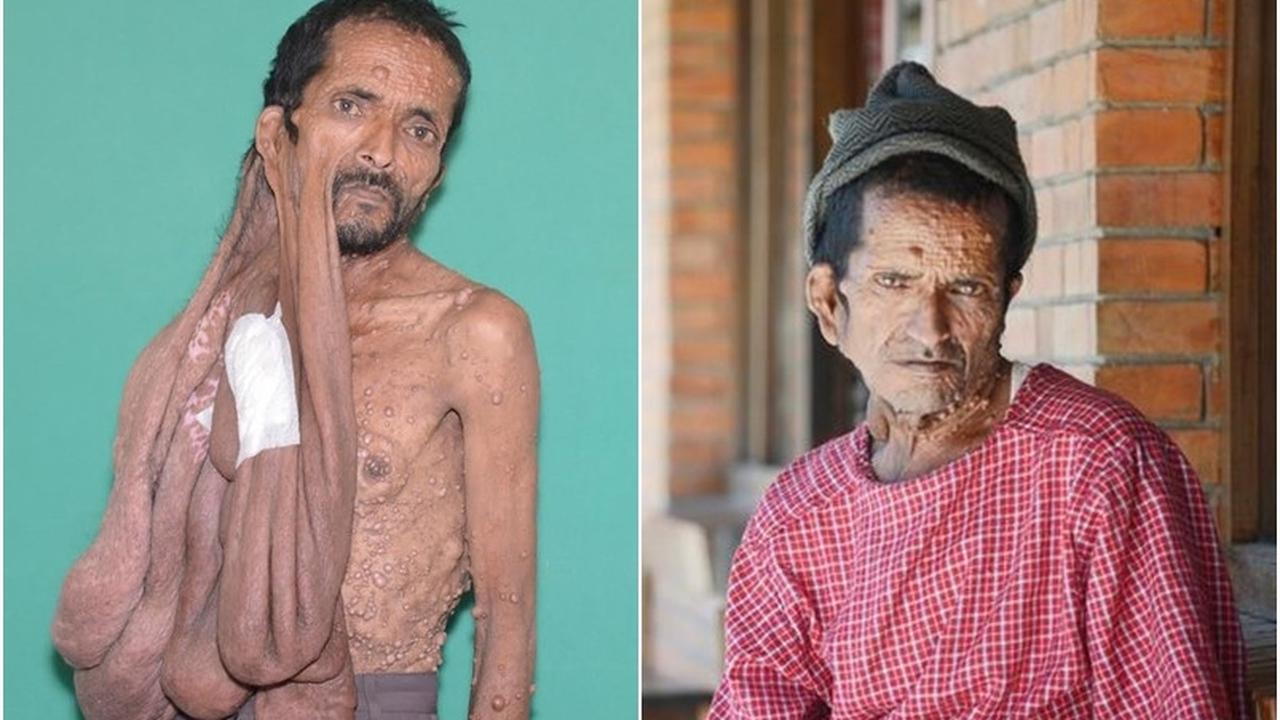 Operasi Sukses, Pria dengan Tumor Wajah Seperti Dilahirkan Lagi