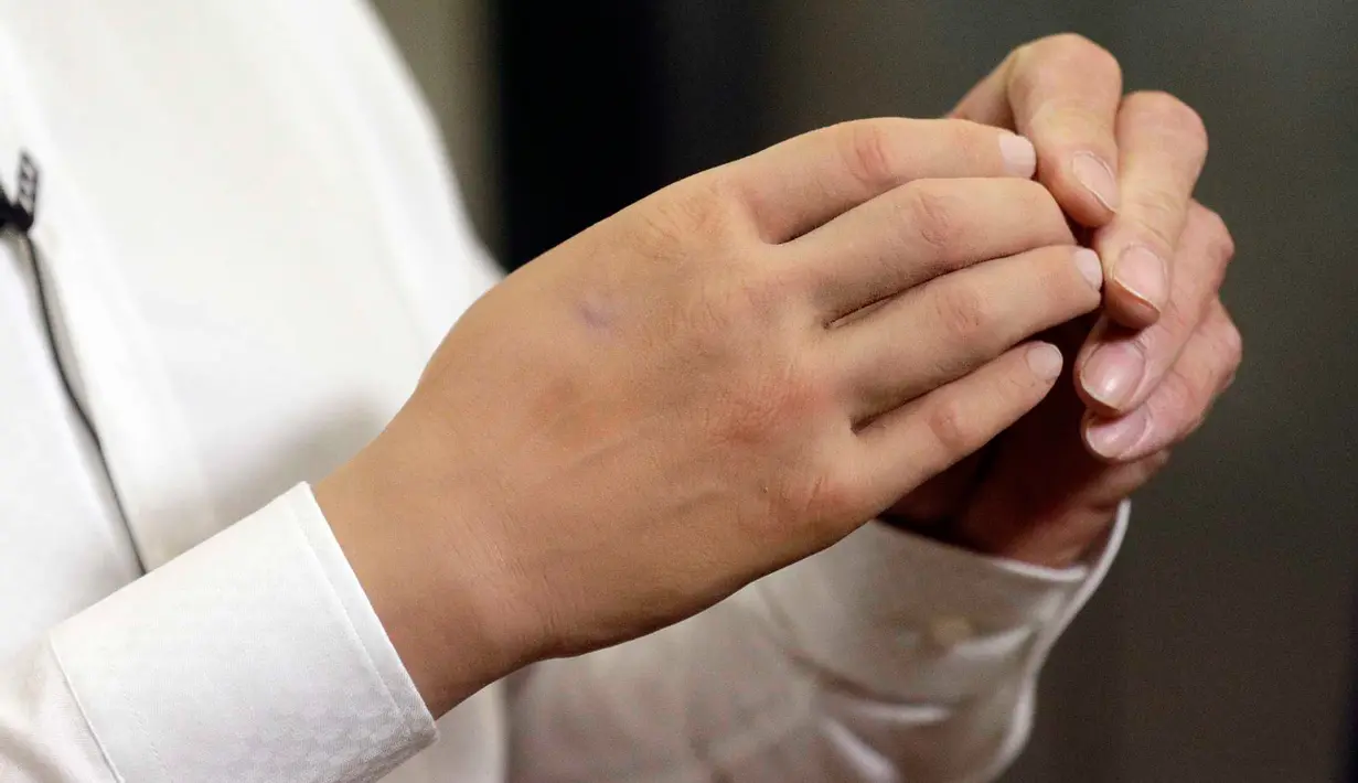 Marco Zambelli memakai tangan prostetiknya dalam wawancara dengan Associated Press di Roma, 10 Mei 2018. Tangan robot tersebut juga menampilkan rancangan yang mampu menekan harganya dengan signifikan. (AP/Gregorio Borgia)