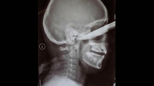 4 Foto Rontgen Ini Bikin Ngilu Ada Yang Tertancap Di Kepala Citizen6 Liputan6 Com