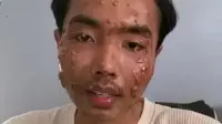 Waduh, TikToker Kena Penyakit Kulit Mengerikan karena Pakai Baju Bekas Tanpa Dicuci