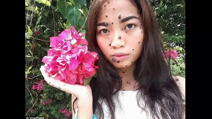 [Bintang] Derita Evita, Gadis yang Memiliki Tahi Lalat di Sekujur Tubuh