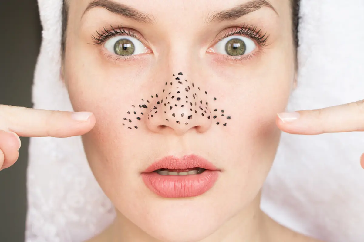 Terganggu Komedo Hitam di Hidung? Hilangkan dengan Perawatan Rumahan Ini