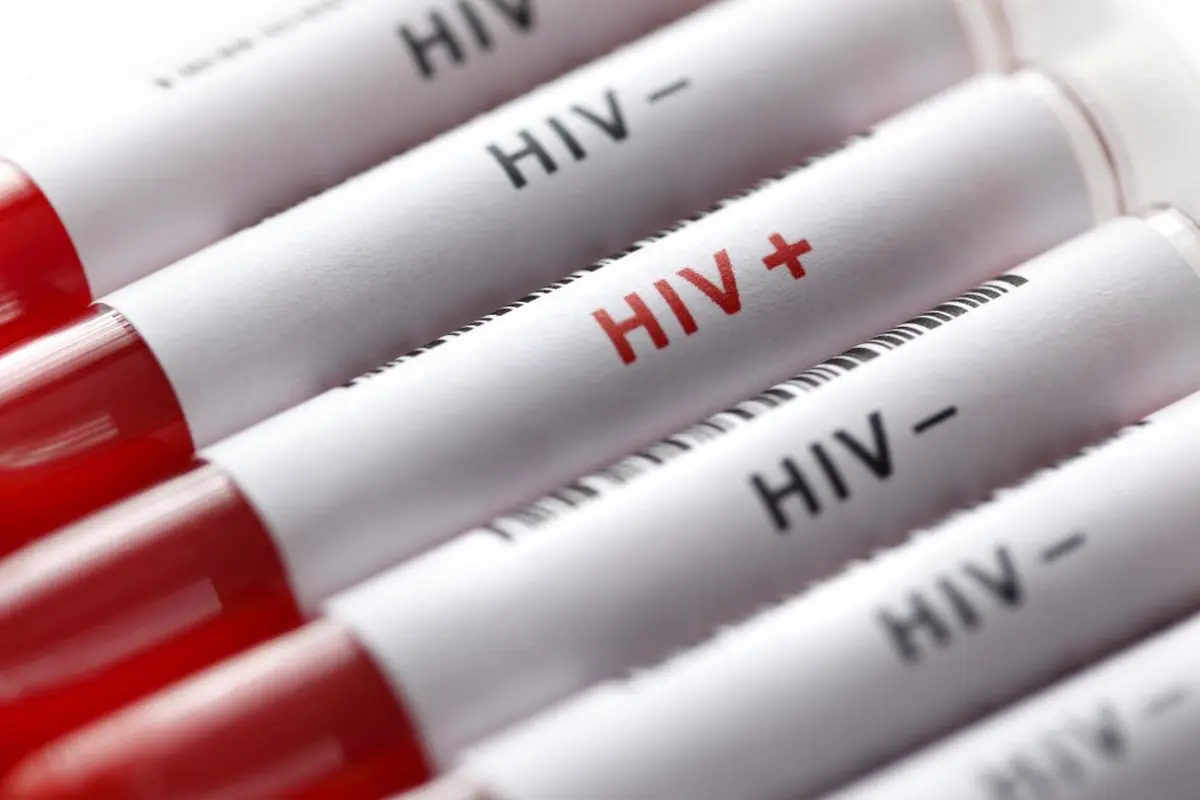 Apa Itu HIV? Kenali Gejala, Penyebab, Pengobatan, dan Perbedaannya dengan AIDS