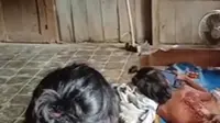 Video seorang anak terkapar tak berdaya dengan luka bakar di punggung hingga ke bagian bokong viral di media sosial. (Liputan6.com/ Dok Ist @yuni.rusmini.58)