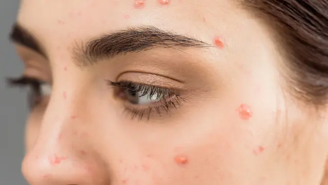 Manfaat Obat Totol Jerawat: Benarkah Ampuh untuk Atasi Jerawat Secara Instan?