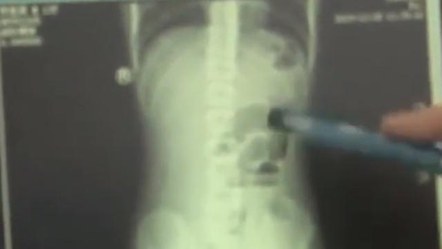 Ketagihan Minum Boba, Remaja Ini Alami Penyumbatan di Usus