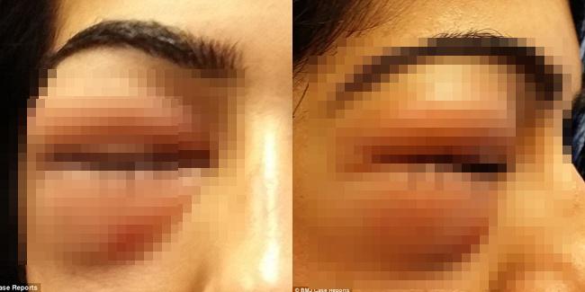Mata wanita yang bengkak setelah buang ingus | Photo: Copyright dailymail.co.uk