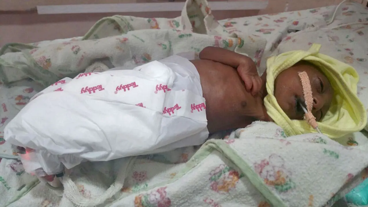 Lahir dengan Wajah Aneh, Bayi Ini Diabaikan Ibunya
