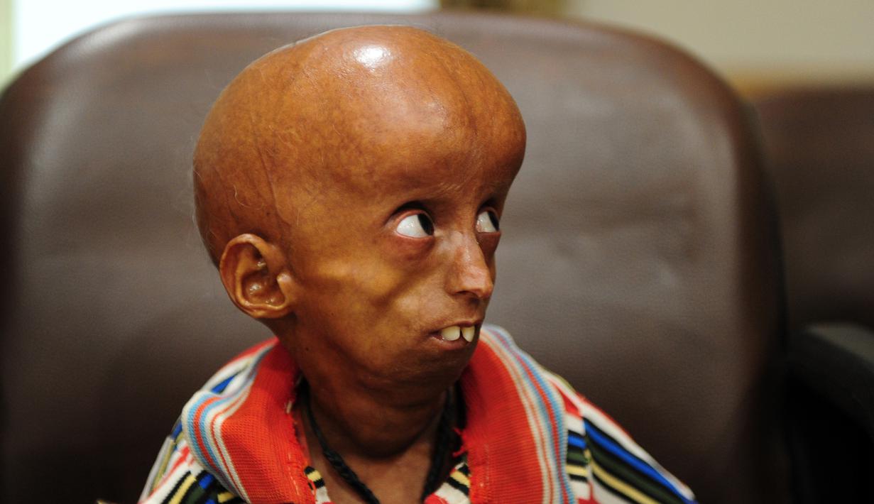 Rupesh Kumar (21) mencari bantuan dana untuk penyakitnya di Kantor Magistrat Allahabad, India, Selasa (2/5). Rupesh yang memiliki bobot 19 kilogram ini bisa saja penyintas progeria tertua di dunia setelah Leon Botha dari Afsel. (SANJAY KANOJIA / AFP)