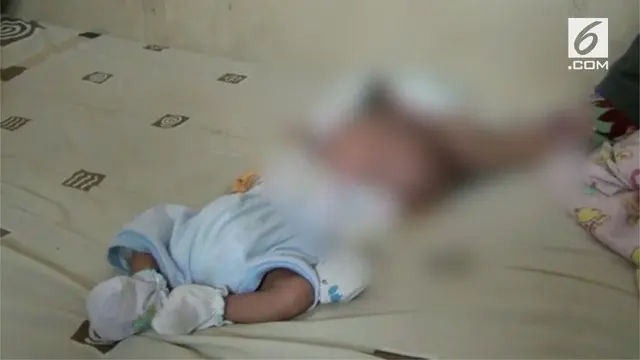 Gilang Andika, bayi yang terlahir dengan dua wajah dan otak terpisah di Batam, Kepulauan Riau, sangat membutuhkan bantuan.
