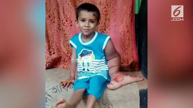 Tajbir Akhtar, anak di Bangladesh yang memiliki ukuran tangan kiri lebih besar dari tangan kanannya.