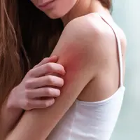 Ilustrasi Biang Keringat Credit: pexels.com/Joene