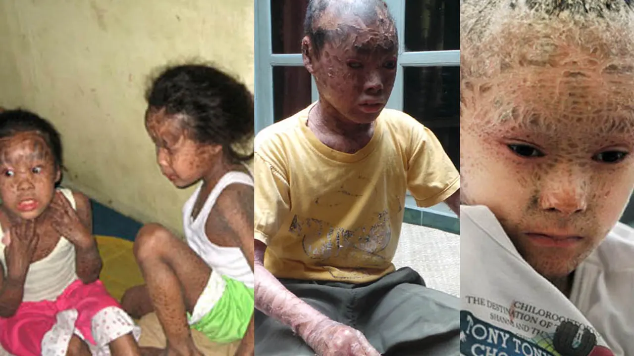 6 Manusia Bersisik yang Menghebohkan