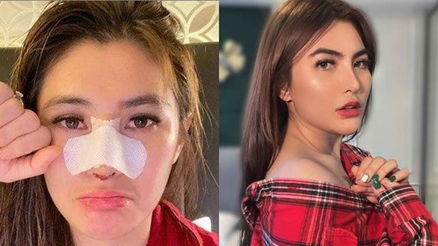 Beda Penampilan 5 Seleb Wanita Tanah Air Jalani Operasi Plastik saat Diperban Vs Setelahnya