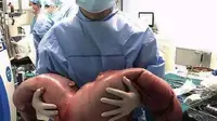 Dokter mengeluarkan kotoran dari usus besar pria China. (Shanghai Tenth People Hospital)