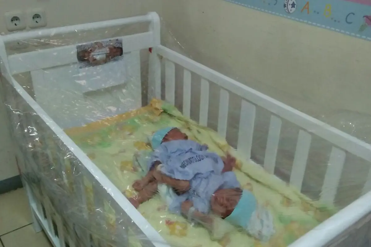 Bayi Kembar Siam Dempet