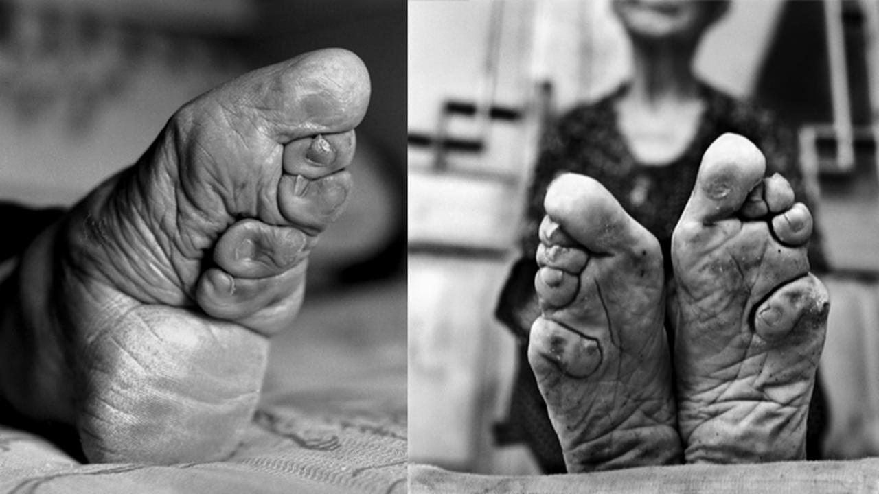 Tampil Cantik, Wanita di China Remukan Jari Kaki