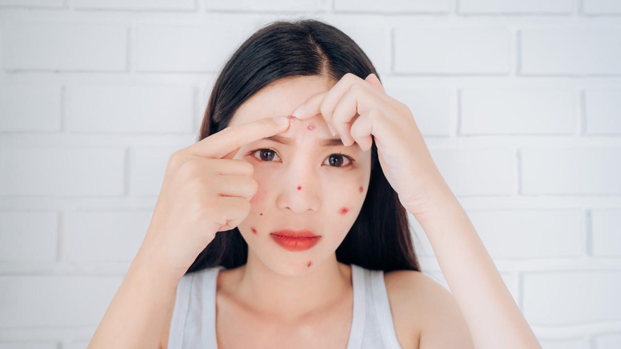 Tanpa Perlu Repot, Begini Perawatan Wajah yang Bisa Dilakukan Saat Mengalami Breakout